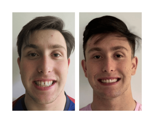 arreglar-dientes-sin-brackets-pacientes-1