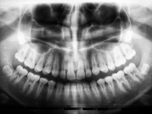 dientes-chuecos-hiperdoncia