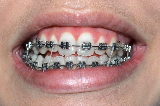 Tipos de ortodoncia: Conoce cuál es la mejor para ti